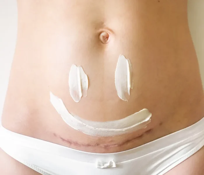 keizersnede behandelen