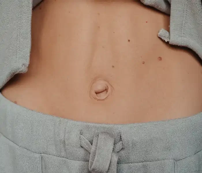 diastase-recti
