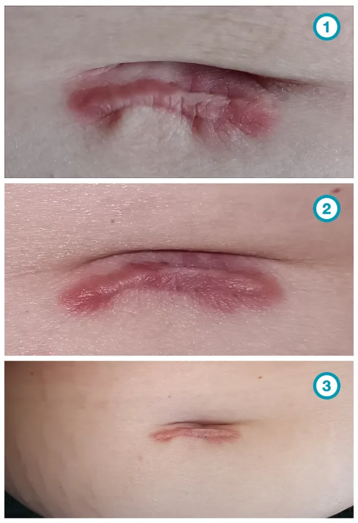 keizersnede litteken